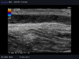 Ultrazvok žil nog - tromboza vene saphene magne 